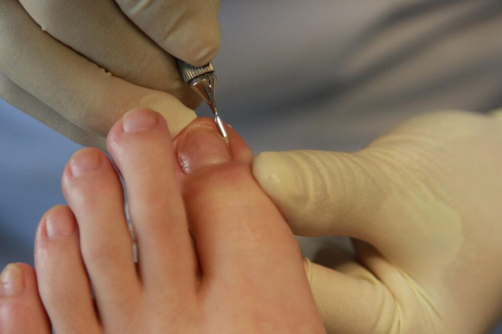 Tratamiento podológico profesional para uña encarnada. La imagen representa la intervención precisa y cuidadosa por parte del equipo especializado para aliviar el dolor y evitar complicaciones. Centro Fisher (Las Águilas – Aluche)