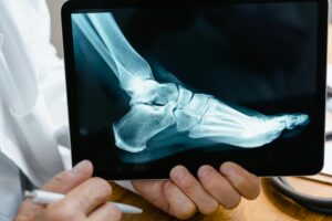 Radiografía de diagnostico para juanetes hallux valgus en Madrid