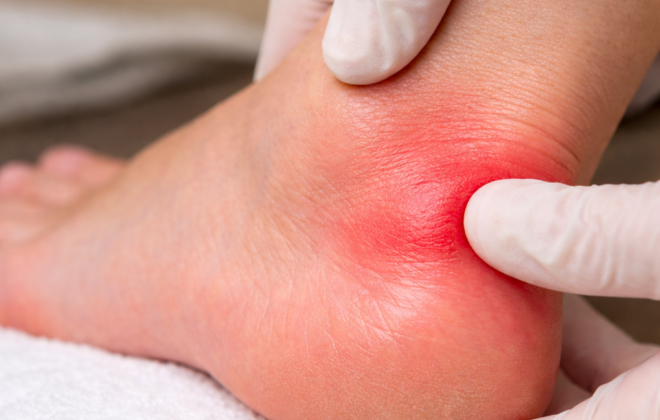 Bursitis en el talón del pie con inflamación visible durante exploración